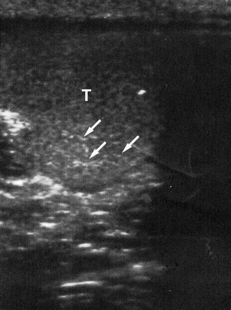 Ultrasonographic Image Of A Patient With Bilateral Testicular