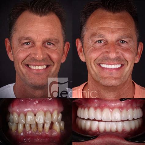 Dental Implants Turkey, Same day teeth Antalya : Dental Excellence ...