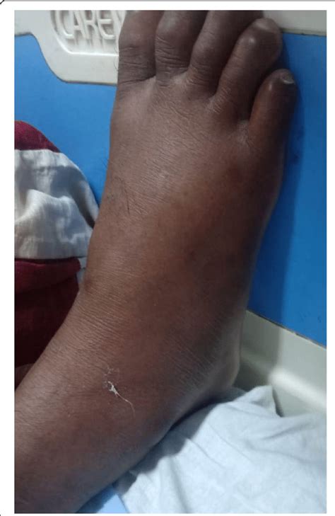 Photograph Of Right Foot Showing Cellulitis Note The Prominent Download Scientific Diagram