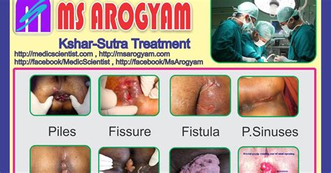Fistula In Ano Ayurvedic Treatment By Kshar Sutra Ayurveda ANAL FISSURES Ayurvedic Treatment