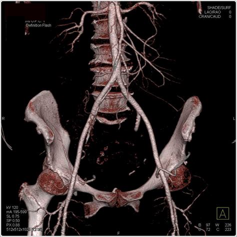 External Iliac Artery