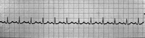 Ecg Ritmo Sinusal Arritmias Del Nodo Sinusal Cardio Science