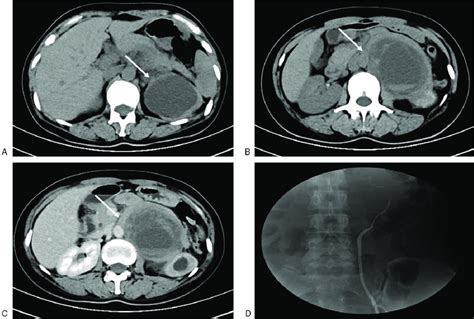 Radiologic Features Of The Retroperitoneal Mass A Ct Scan Revealed Download Scientific