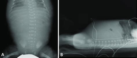 Gasless Abdomen On Simple Abdominal Radiography Supine A And