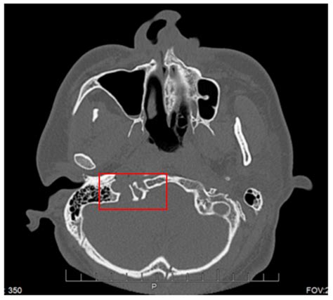 Hypoglossal Canal