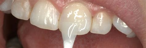 Фторирование молочных зубов - TopDentalClinics.ru
