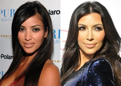 Kim Kardashian Plastic Surgery Plastic Celebrity Surgery