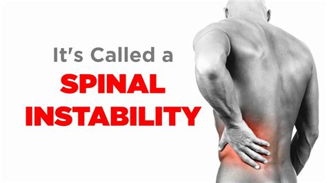 Spinal Instability Video 1 Youtube