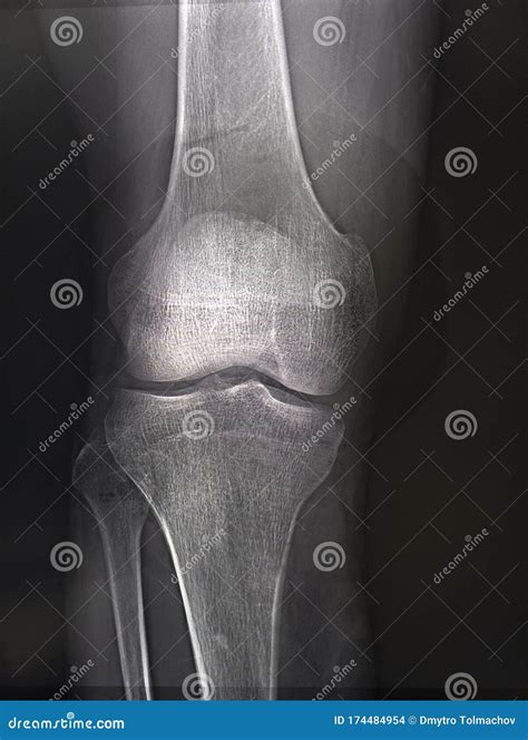 Knee X-rays Image Royalty-Free Stock Photo | CartoonDealer.com #27953763