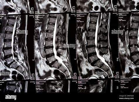 Cairo Egypt December 24 2023 L5 Vertebrae Spinal Laminectomy