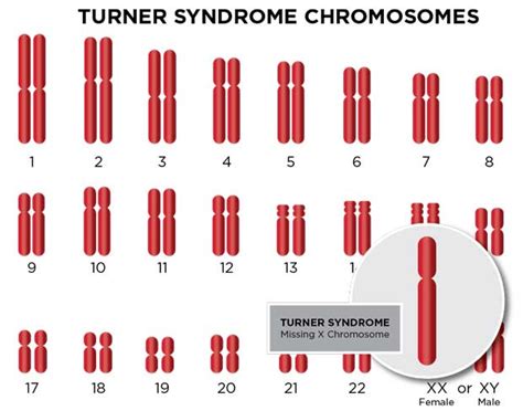 Turner Syndrome Chromosomes