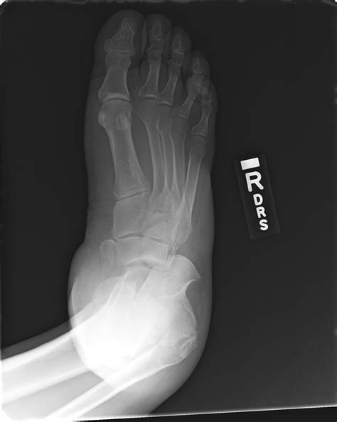 FOOT FRACTURE - Buyxraysonline