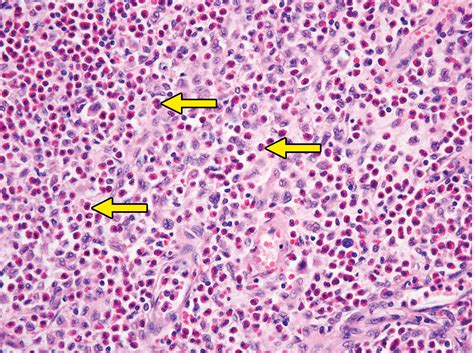 Imaging Of Histiocytosis In The Era Of Genomic Medicine Radiographics