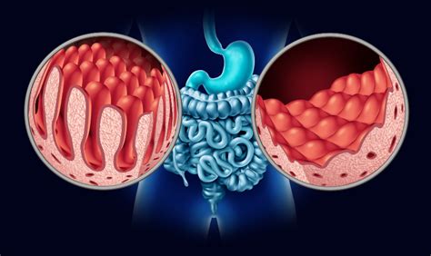 Gluten And Lipedema