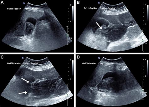 Spontaneous Acalculous Gallbladder Perforation Post Cardiac Transplantation Bmj Case Reports