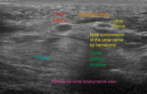 Ulnar Nerve Block at the Wrist - Clinical Tree