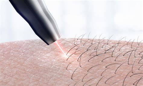 Some Important Pros And Cons Of Laser Hair Removal