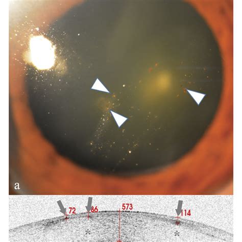 Anterior Segment And As Oct Image For Case A Anterior Segment