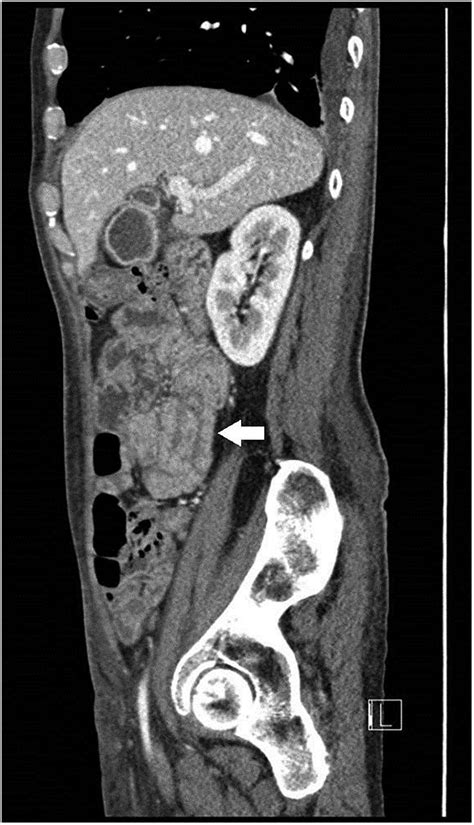 A Case Of Adult Intussusception Bmj Case Reports