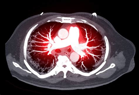 Cta Pulmonary Arteries 3d Rendering Showing Branch Of Pulmonary Artery