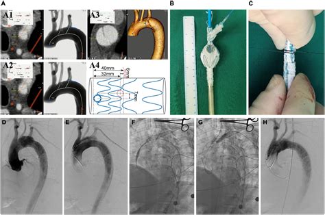 Frontiers Single Branched Stent Graft With On Table Fenestration For