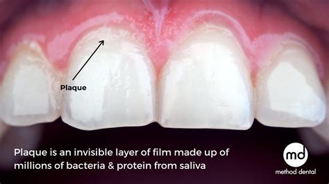 What is dental plaque - Method Dental