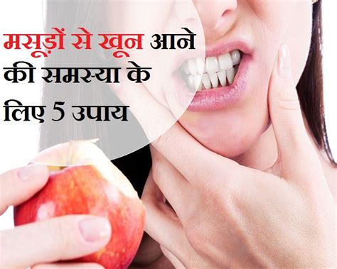 क्या आपको भी मसूड़ों से आता है खून तो पढ़ें घरेलू उपाय 5 Home