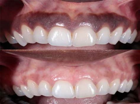 Gum Depigmentation Delhi India Cost Of LASER Gums Depigmentation Gum