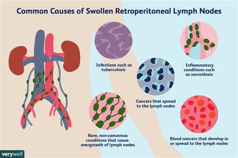 Retroperitoneal Lymph Nodes Cancer Symptoms