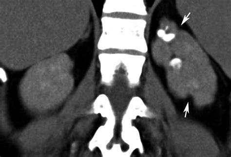 Radiodiagnosis Imaging Is Amazing Interesting Cases Renal