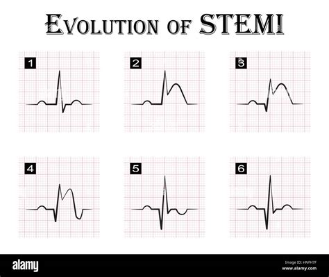 Stemi Ecg Examples