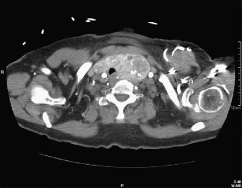 Contrast Enhanced Computed Tomography Scan Shows A Sharply Marginated