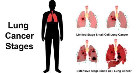 Limited Vs Extensive Stage Small Cell Lung Cancer Bis Research News