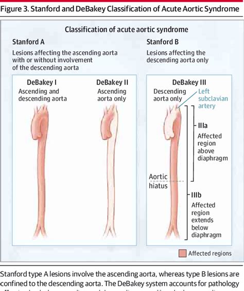 Figure 3 From Acute Aortic Dissection And Intramural Hematoma A