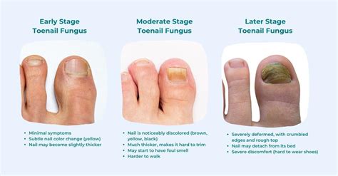 Can You Get A Pedicure If You Have Toenail Fungus Purehealth Research