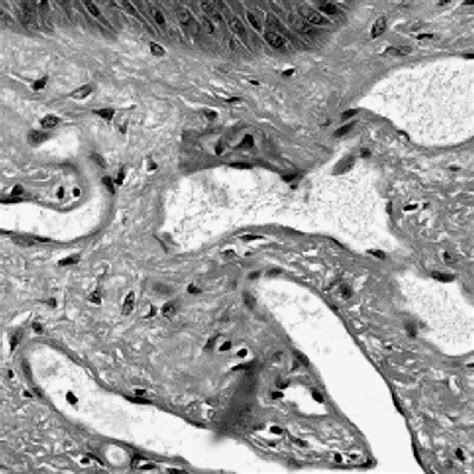 Lower Extremity Pitting Edema