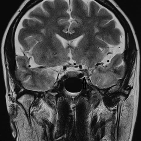 Coronal T2weighted Magnetic Resonance Image T2W MRI Shows Subtle