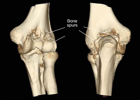 bone-spurs-may-limit-motion - Shoulder & Elbow
