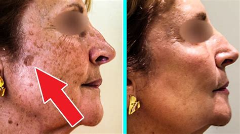 Вот как бороться с пятнами на коже и пигментацией. Простой метод ...