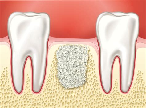 Knochenaufbau Wenn Der Kieferknochen Nicht Zum Implantat Passt