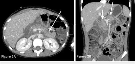 Ct Abdomen And Pelvis With Iv Contrast Revealing Pancreatic Download Scientific Diagram