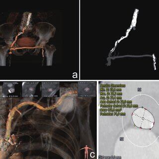 successful safe cutdown approach   left axillary artery