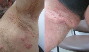 Acd A Z Of Skin Hidradenitis Suppurativa