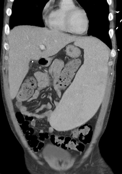 Contrast Enhanced Computed Tomography Of Abdomen Showing Massive