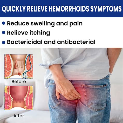 Ouhoe Hemorrhoids Ointment Relieve Pain Hemoroid Cream Anal Bleeding Swelling Anal Fissure