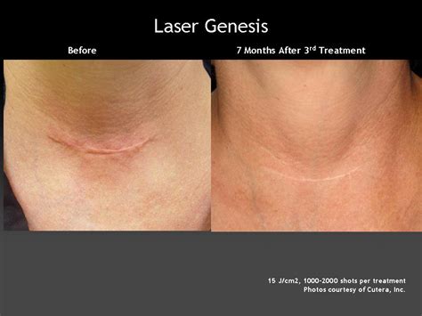 Laser Genesis Tamra Bedford Cosmetic Rn 925 518 5212