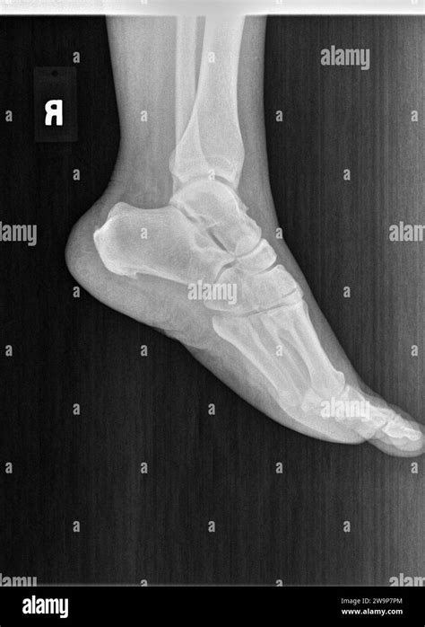 Normal Foot Xray Lateral View Images