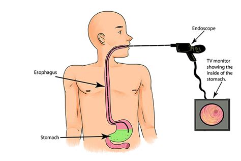 Medical use of optical fibres