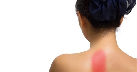Upper Left Back Pain: Symptoms, Causes, and Treatment