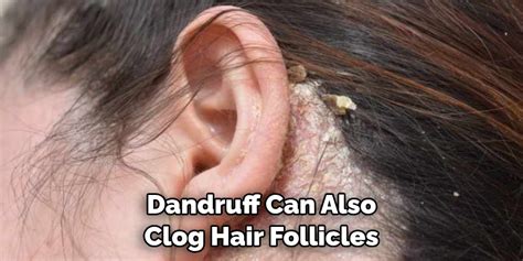 how to get dandruff out of locs